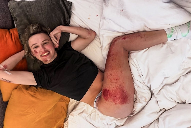 Blaže posljedice pada s bicikla tijekom utrke